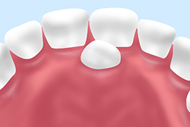 過剰歯（かじょうし）の抜歯