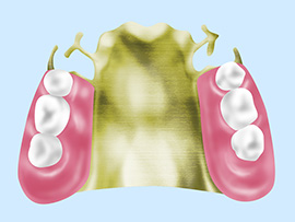金属床義歯（コバルトクロム・ゴールド・チタン）