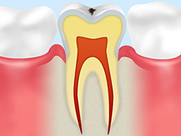 C1エナメル質のむし歯