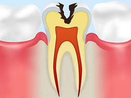 C2象牙質に達したむし歯