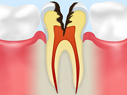 C3神経に達したむし歯