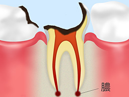 C4歯根に達したむし歯