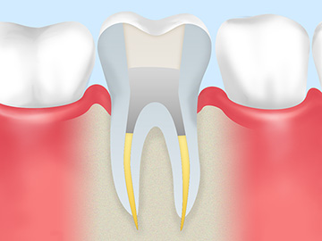 残せる歯は残す、根管治療を行っています