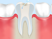 【STEP　02】根管を洗浄・消毒する