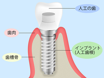 患者さんとご相談しながらインプラント治療をご提案します