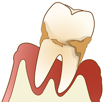 知らないうちに歯周病になっているかもしれません