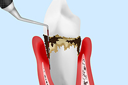 歯周ポケット検査