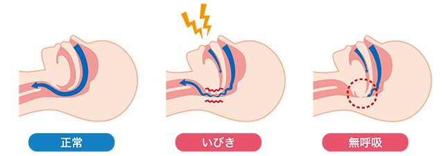 睡眠時無呼吸症候群とは